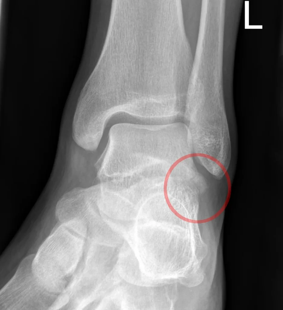 Talus bone fracture